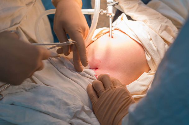 Las manos cercanas de los cirujanos pediátricos realizan la cirugía utilizando puertos laparoscópicos para la cirugía endoscópica. En un quirófano estéril. Cirugía pediátrica, tratamiento de la hernia inguinal en niños por PIRS, sutura del anillo inguinal interno. Dropsia de
  - Foto, imagen