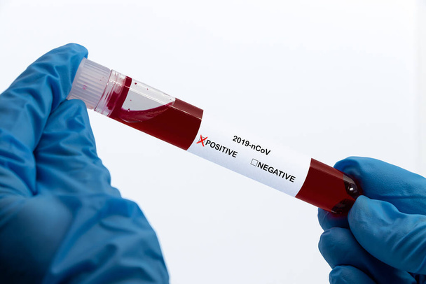 Mani che tengono il campione di sangue nel tubo sottovuoto con analisi positiva del coronavirus 2019-nCoV, isolato su bianco
 - Foto, immagini