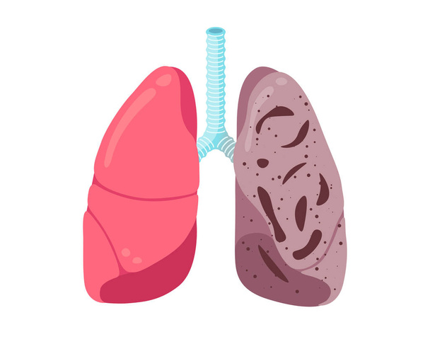 Больной нездоровый туберкулёз легких. Внутренняя часть органов дыхания человека поражена туберкулезной палочкой или пневмонией. Иллюстрирование вектора повреждений медицинской анатомии
 - Вектор,изображение