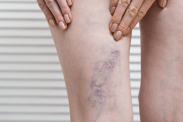 Mujer muestra pierna con venas varicosas. Varicosa durante el embarazo
. - Foto, Imagen