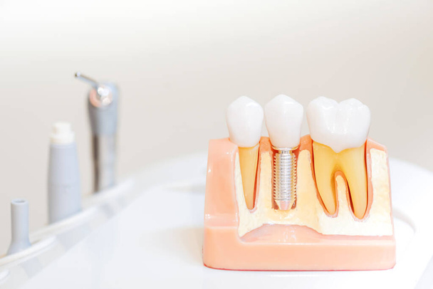 зубний імплантат фальшиві зуби. Концепція стоматології та охорони здоров'я в стоматологічній клініці
. - Фото, зображення