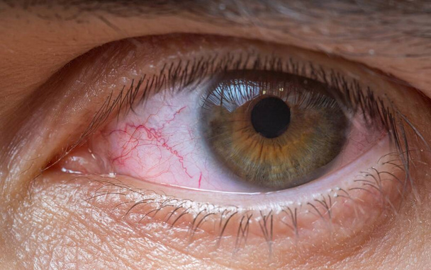 Widok z bliska na czerwone zranione lub podrażnione oko. - Zdjęcie, obraz