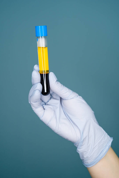 Hand girl doctor glove holds test tube with blood plasma - Foto, imagen