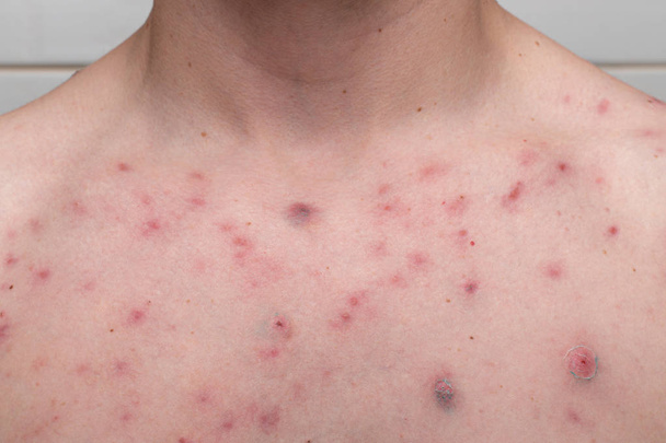 acné sur une poitrine masculine. résultat de l'utilisation de stéroïdes et anabolisants
 - Photo, image