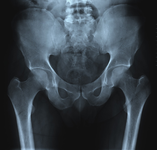 Röntgenbild des Beckens - Foto, Bild