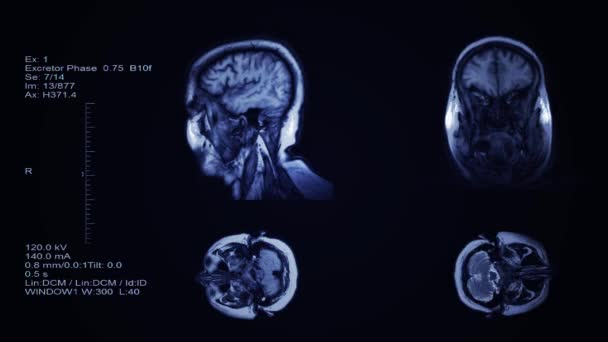 Hoofd-en hersencomputer tomografie resultaat visualisatie. Vier partities dia 's van het menselijk hoofd screening. 3d medisch radiologie onderzoek - Video