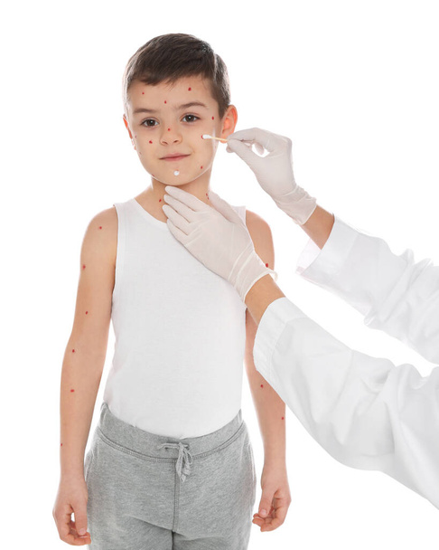 Doctor applying cream onto skin of little boy with chickenpox on white background. Varicella zoster virus - Фото, зображення