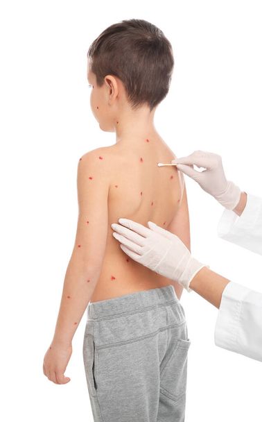 Doctor applying cream onto skin of little boy with chickenpox on white background. Varicella zoster virus - Fotografie, Obrázek
