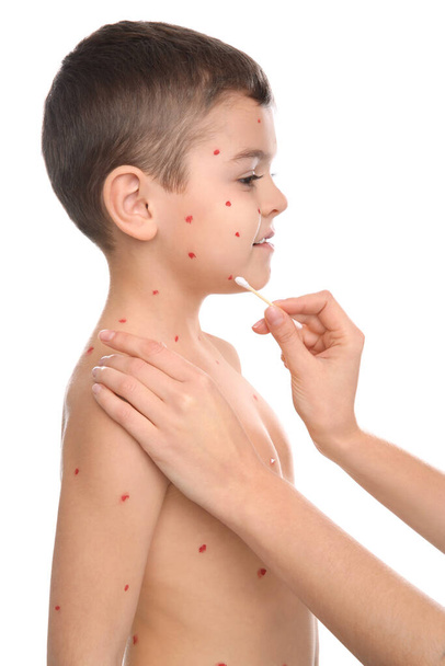 Woman applying cream onto skin of little boy with chickenpox on white background - Фото, изображение
