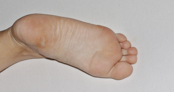 İnsan papillomavirüsü ya da HPV 'nin neden olduğu ayak topuğunun altındaki bir ayak siğilinin yakın çekim görüntüsü.. - Fotoğraf, Görsel