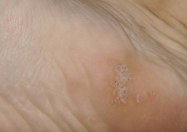 Zbliżenie strzał brodawki plantarnej na dole pięty stopy spowodowane przez wirusa brodawczaka ludzkiego, lub HPV. - Zdjęcie, obraz