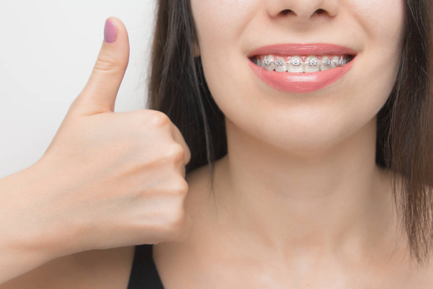 Appareils dentaires dans la bouche des femmes heureuses qui montre comme. Supports sur les dents après le blanchiment. Supports auto-ligaturants avec attaches métalliques et élastiques gris ou élastiques pour un sourire parfait. Traitement des dents orthodontiques
 - Photo, image