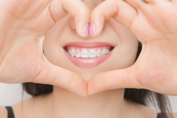 Dental braces in happy womans mouths through the heart. Brackets on the teeth after whitening. Self-ligating brackets with metal ties and gray elastics or rubber bands for perfect smile. Orthodontic teeth treatment - Foto, Imagen