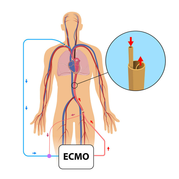 Oxygénation extracorporelle de membrane, ecmo dans le département de soins intensifs
  - Photo, image