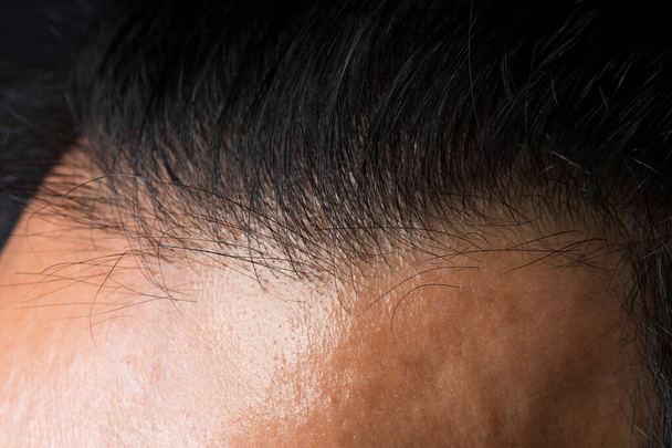 Detailní makro portrét mužské části hlavy vlasy, člověk otevřít tenké vlasy oblasti na zadní části horní kruh hlavy vidět přírodní vrásky, kořen, vlasovou pokožku a problém tenkých vlasů, téměř plešatý - Fotografie, Obrázek
