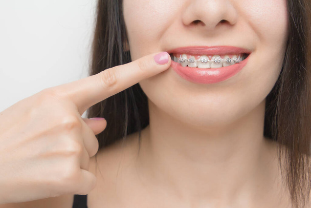 Tandbeugels in vrolijke vrouwen monden die met de vinger op beugels op de tanden laten zien na het bleken. Zelfklevende beugels met metalen banden en grijze elastieken of elastiekjes voor een perfecte glimlach. Orthodontische tandbehandeling - Foto, afbeelding
