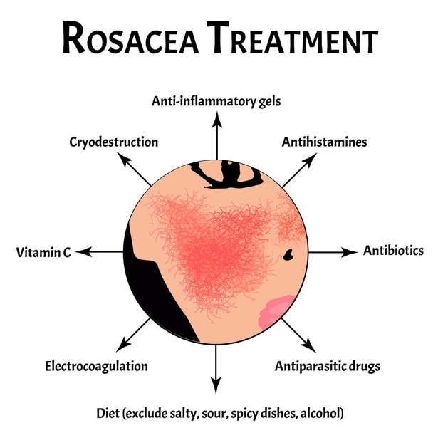 Ursachen von Rosazea. Rosacea Awareness Month. Infografiken. Vektor-Illustration auf isoliertem Hintergrund. - Vektor, Bild