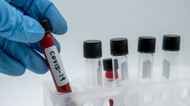Teste COVID-19 positivo e amostra laboratorial de exames de sangue para diagnóstico de nova infecção pelo vírus Corona. Doença 2019 de Wuhan. Conceito infeccioso pandêmico
 - Foto, Imagem