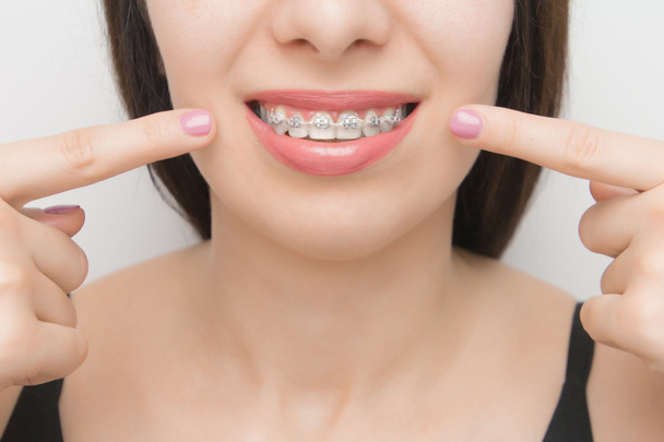 Dental braces in happy womans mouths who shows by two fingers on brackets on the teeth after whitening. Self-ligating brackets with metal ties and gray elastics or rubber bands for perfect smile. Orthodontic teeth treatment - Photo, Image
