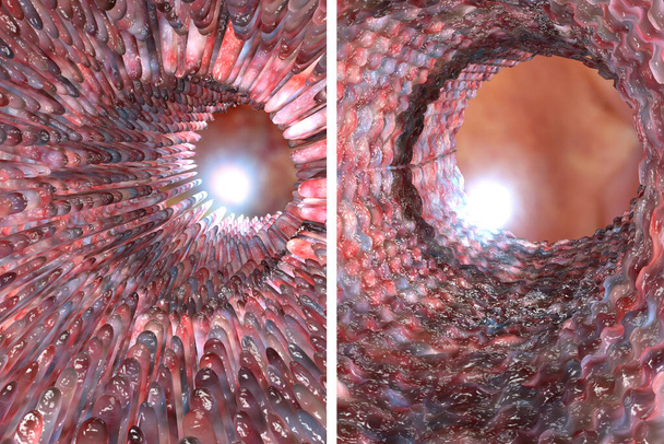 Celiakia jelita cienkiego z atrofią złośliwą w porównaniu do zdrowych villi do porównania 3D ilustracja cyfrowa - Zdjęcie, obraz