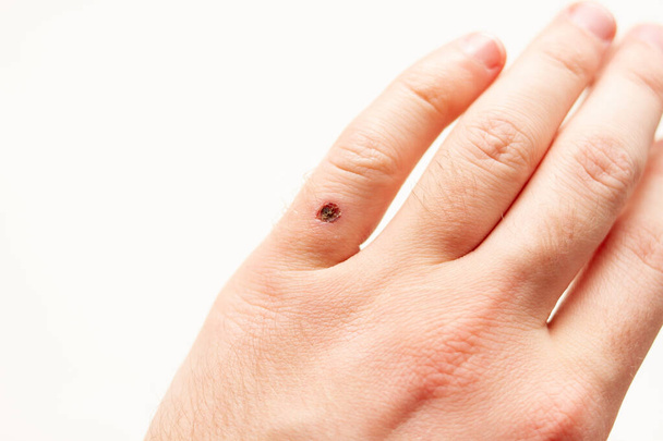 un dito dolorante dopo la rimozione della verruca con azoto liquido
 - Foto, immagini