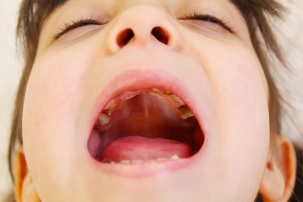 Hammaslääketiedettä. Lapsi, jolla on avoin suu, puhdistaa vaurioituneet hampaat. Valikoiva painopiste
 - Valokuva, kuva
