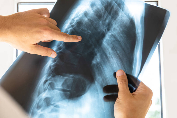médico examina imagen de rayos X de la columna vertebral humana y el pecho
 - Foto, imagen