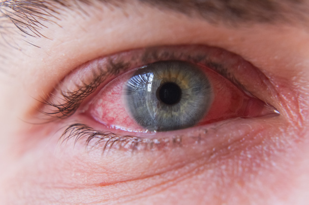 Macro close-up de olho vermelho com infecção conjuntivite
 - Foto, Imagem