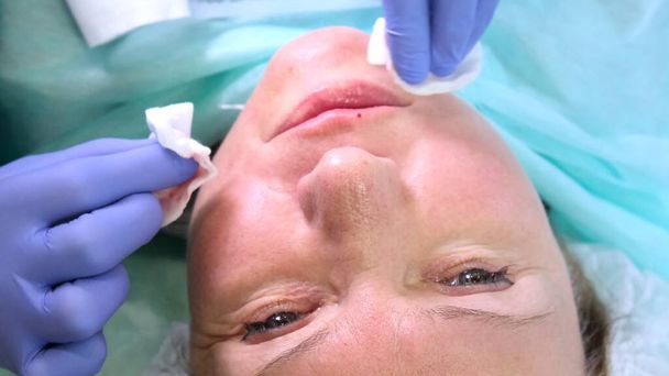 Kosmetologi lääkäri valmistelee naisten kasvot kosmeettiseen injektioon, hyaluronihapon injektioihin. Nainen kauneushoitolassa. plastiikkakirurgia klinikka
 - Valokuva, kuva