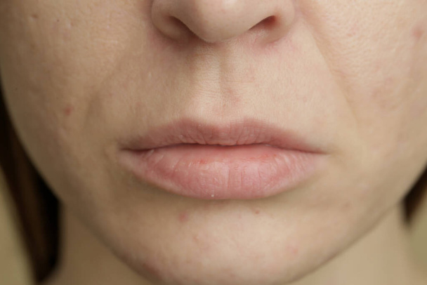 Gros plan de la peau sensible problématique du visage féminin avec de gros pores, rougeur et acné
  - Photo, image