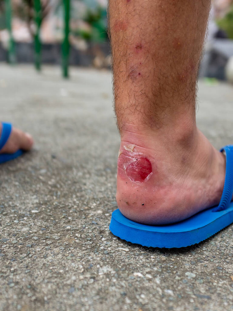 Der Fuß des weißen Mannes trägt blaue Sandalen, sein Knöchel ist geschält und abgeschabt, sein Bein ist von Mückenstichen befallen - Foto, Bild