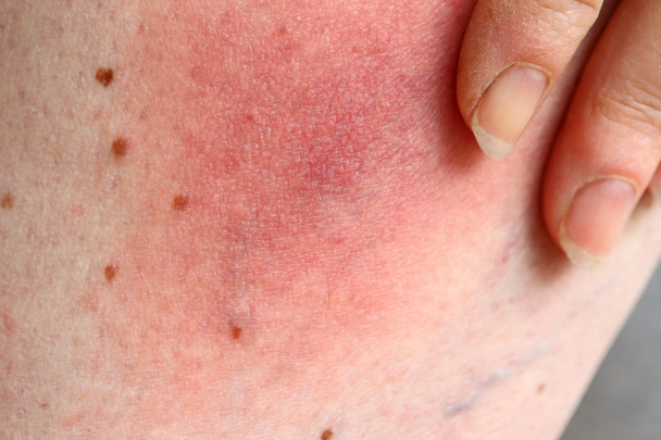Arrossimento di una malattia da borreliosi di Lyme zecche sulla gamba di una donna. Arrossamento della pelle sulla gamba a causa di un'allergia
 - Foto, immagini