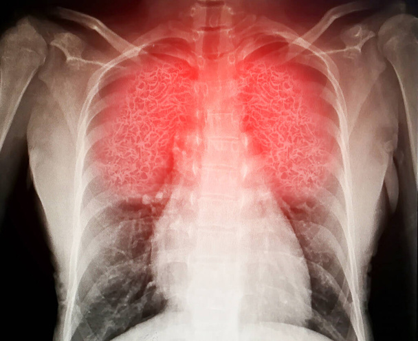 ウイルスは人間の肺を破壊します - 写真・画像