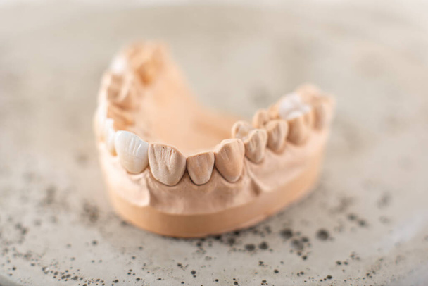 Model of artificial jaw with veneers - Photo, Image