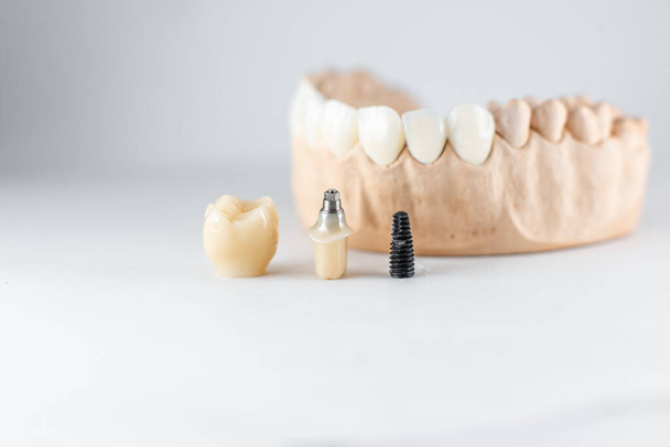 Model of artificial jaw and dental implant - Photo, Image
