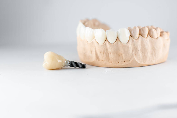 Model of artificial jaw and dental implant - 写真・画像