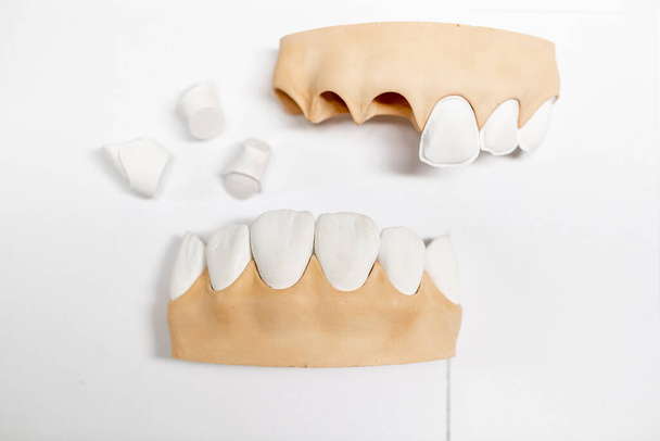 Plaster models of jaw fragment - 写真・画像