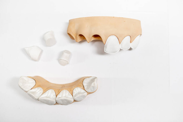 Plaster models of jaw fragment - Zdjęcie, obraz