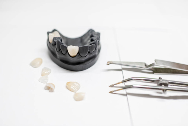 Artificial jaw model with veneers - Fotografie, Obrázek