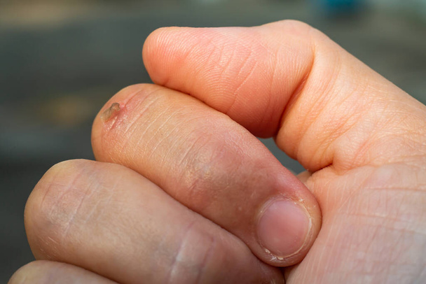 Mulher descascada dedo indicador e cicatriz pele na mão, fundo Bokeh, Close up & Macro tiro, Asian Body skin part, Healthcare concept
 - Foto, Imagem