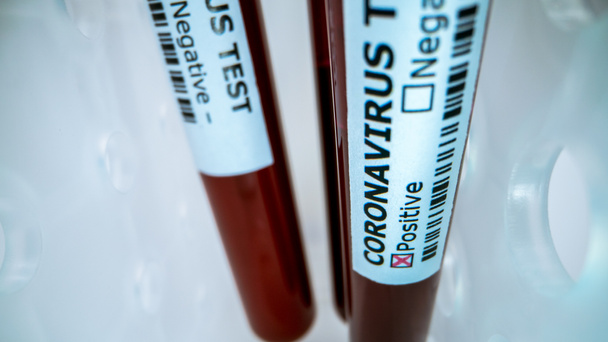 Tubo de amostra de sangue para teste de corona, COVID-19. O vírus causou uma situação de emergência. Pesquisa de vacinas 2019-nCoV. Investigação contra as doenças infecciosas transmissíveis e como protecção da gripe
 - Foto, Imagem