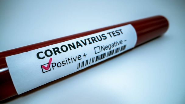 Coronavirus Covid 19 infected blood sample in tube. Vaccine research of virus 2019-nCoV at laboratory. Disease 2019 from Wuhan. Pandemic infectious concept - Foto, afbeelding