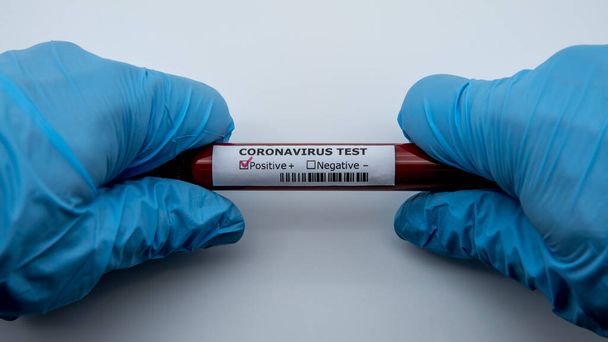 Positive COVID-19 test and laboratory sample of blood testing for diagnosis new Corona virus infection. Disease 2019 from Wuhan. Pandemic infectious concept - Foto, Imagem