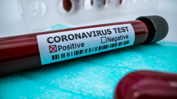 Beschermend masker en positieve COVID-19 test. Laboratoriummonster van bloedonderzoek voor diagnose nieuwe Corona virus infectie. Ziekte 2019 van Wuhan. Pandemisch infectieus concept - Foto, afbeelding