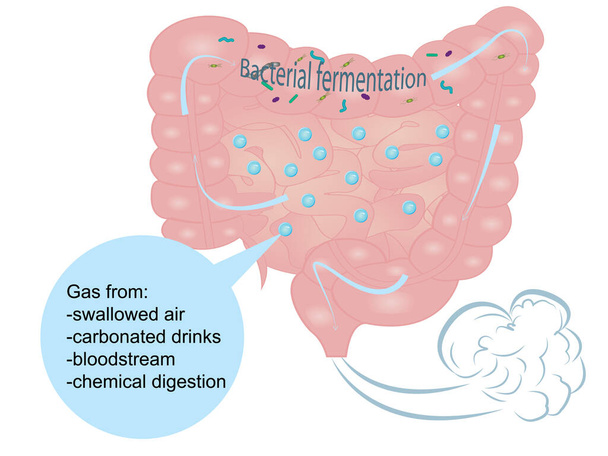 Gonflement et excès de gaz dans l'intestin
 - Vecteur, image