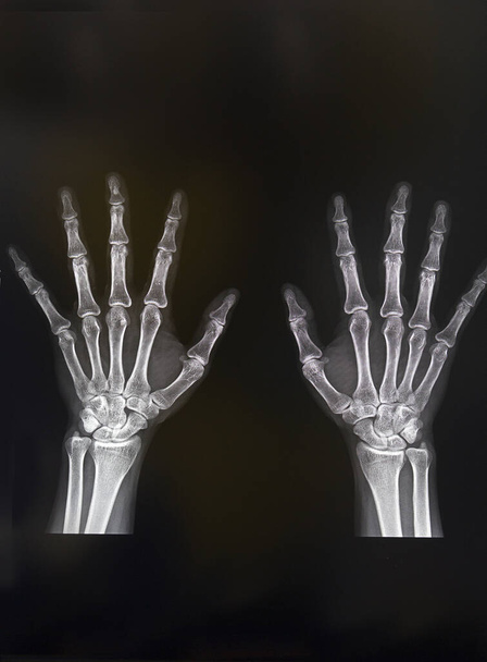 X-ray radiation of the human hand is close-up. Medicine - Photo, Image