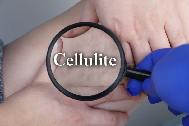 Un médico examina una pierna de un paciente con lipodistrofia. Una lupa muestra celulitis. El concepto de obesidad y tratamiento de la liposclerosis, cáscara de naranja
 - Foto, Imagen