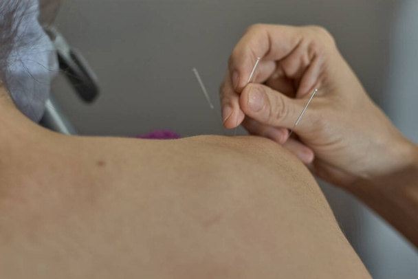 Doktor akupunkturda kadının omzuna iğne batırır. Kapat. - Fotoğraf, Görsel