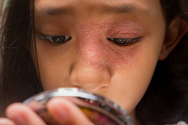 Yüzünde ve burnunda dairesel deri döküntüleri olan Güneydoğu Asya kökenli genç kız aynaya bakıyor. Tinea Corporis dermatit sorunu - Fotoğraf, Görsel