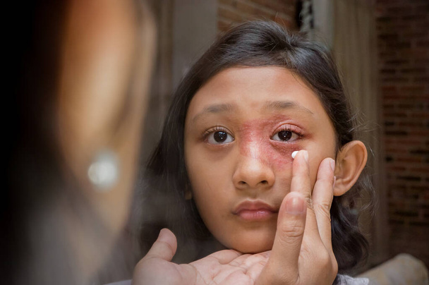 顔に円形の肌の発疹を持つ東南アジアの民族10代の少女は、薬のための抗真菌クリームを適用されています.Tinea Coris皮膚炎の問題 - 写真・画像